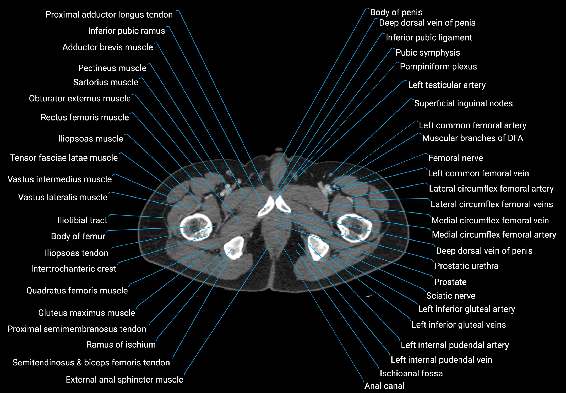 CT male pelvis axial cross sectional anatomy labelled radiology image -00208.webp